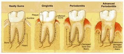 remedios caseros para la gingivitis