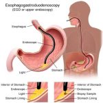 Panendoscopia oral digestiva: 6 cosas que necesitas saber