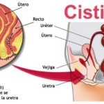 remedios caseros para la sistitis