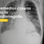 cardiomegalia