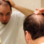 ¿Qué es la alopecia? Interrogantes frecuentes