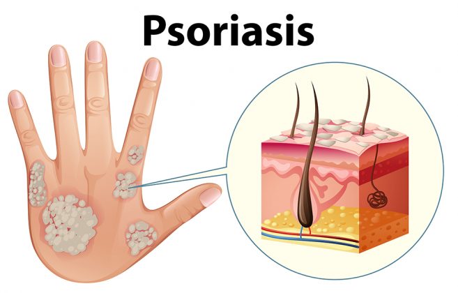 Como Tratar La Psoriasis Una Enfermerdad De La Piel 9124