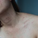 psoriasis de la piel